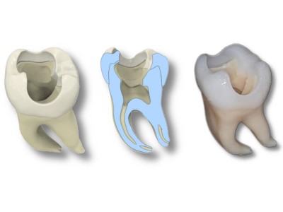 Abbildung von drei Molaren nebeneinander v.l.n.r.: Übersicht des ganzen Zahnes bestehend aus Schmelz und Dentin, Querschnitt des Zahnes, kompletter im 3D-Druckverfahren hergestellte Zahn