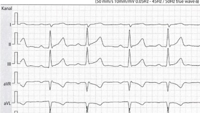 EKG