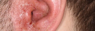 Otitis externa