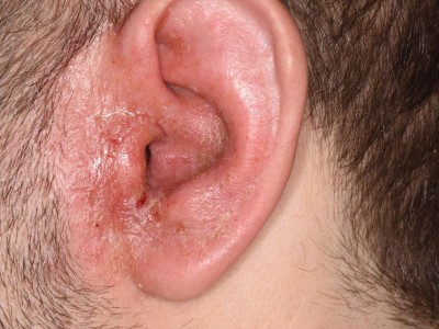 Otitis externa