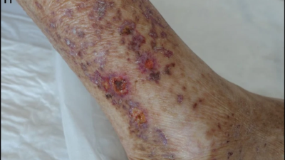 Cryoglobulinemic vasculitis flare after daratumumab
