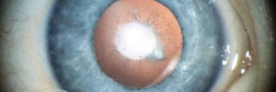 Kind mit dichter unilateraler Katarakt