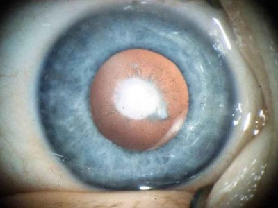 Kind mit dichter unilateraler Katarakt