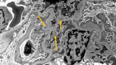 Analysis of kidney biopsy of SLE patient presenting with abdominal pain