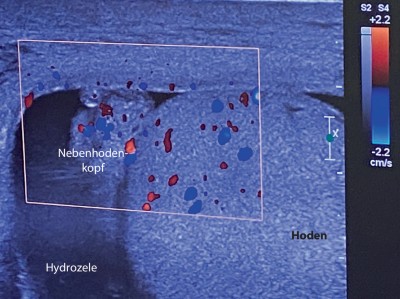 Epididymitis mit verdicktem Nebenhodenkopf, entzündlicher Hyperämie und Begleithydrozele