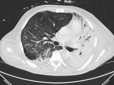 CT-Befund des Thorax