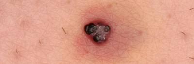 Hautveränderung am Unterschenkel