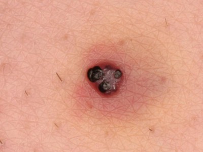 Hautveränderung am Unterschenkel