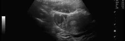 Abdomensonographie: 14,7 mm große zystische Struktur im Bereich des rechten Ovars