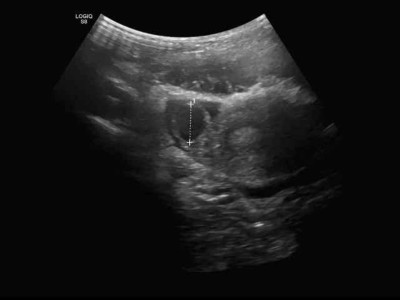 Abdomensonographie: 14,7 mm große zystische Struktur im Bereich des rechten Ovars