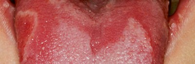 Offener Mund mit herausgestreckter Zunge. in der Mitte der Zunge ist eine große herzförmige und weißliche Verfärbung der Oberfläche zu sehen.