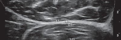  Sonographiequerschnitt über der Hälfte des M. quadriceps (Normalbefund)