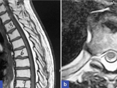 Intraspinales thorakales Lipom