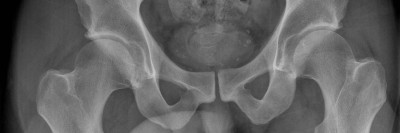 Pincer-Konstellation, Hüftdysplasie und CAM-Impingement im Röntgenbild