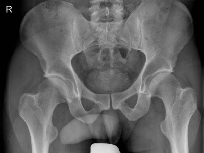 Pincer-Konstellation, Hüftdysplasie und CAM-Impingement im Röntgenbild