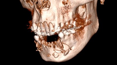 Bild einer dreidimensionalen digitaler Volumentomographie: Kiefer und Zähne sind zu sehen. Im Unterkiefer fehlen Zähne 33-44.