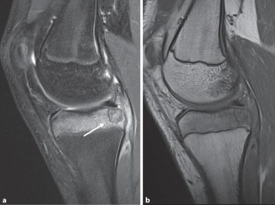 Chondroblastom in der MRT