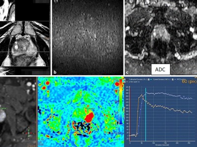 Muzinöses Prostatakarzinom