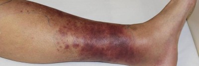 Hämorrhagisches Erysipel am Unterschenkel