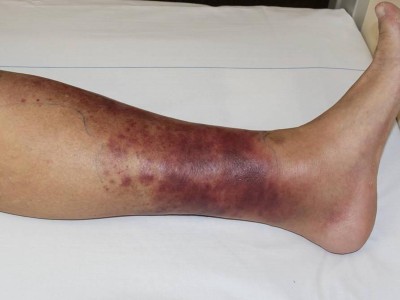 Hämorrhagisches Erysipel am Unterschenkel