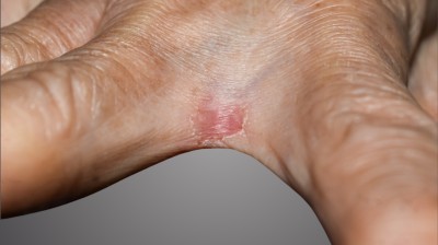 Pilzinfektion der Hand