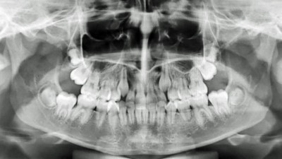 Orthopantomogramm mit verlagerten Eckzähne und zweiten Molaren im Oberkiefer, Zahnkeime der Sapientes in allen vier Quadranten