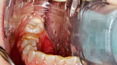 Offener Mund: Wange, Mundboden und Zunge werden von einer bogenförmigen, transparenten Schiene fixiert, die zwischen den Kiefern klemmt.