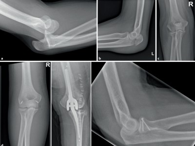 Indikationen zur konventionellen Bildgebung am Ellenbogen