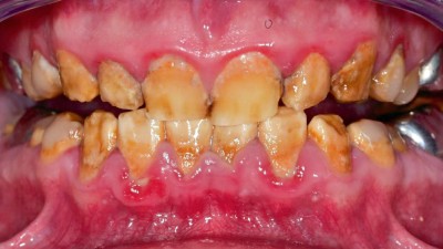 Frontalansicht auf Gebiss in Okklusion: Zähne sind mit gelblich braunem Belag versehen. Zahnfleisch stellenweise gerötet