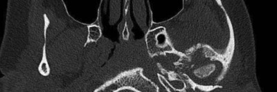  CT des Felsenbeins bei Osteomyelitis der Schädelbasis