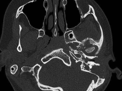  CT des Felsenbeins bei Osteomyelitis der Schädelbasis
