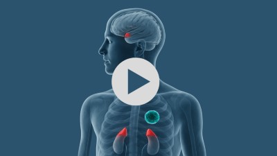 Teaserbild OA Cushing-Syndrom