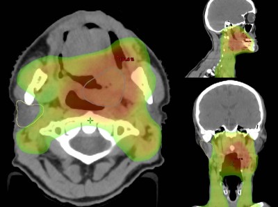 VMAT-Bestrahlungsplan einer definitiven Radiochemotherapie eines linksseitigen, lokal fortgeschrittenen Tonsillenkarzinoms