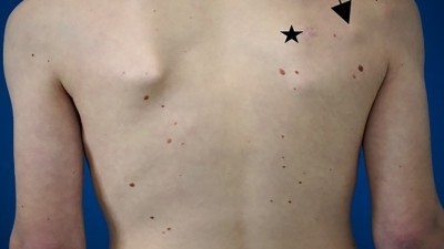 Patient mit Melanom und Metastasen