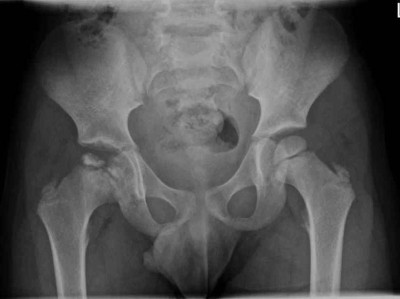  Morbus Perthes rechts bei 5-jährigem Jungen