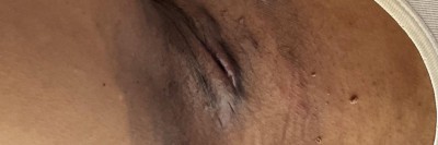 Acne inversa bei einem Patienten