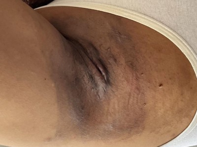 Acne inversa bei einem Patienten