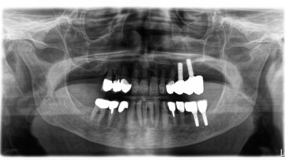 Sofortimplantation mit Sofortbelastung - Abbildung 1