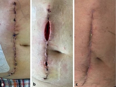 Oberflächliche Wundinfektion nach elektiver Relaparotomie
