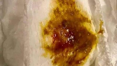 Salmonellen-Enteritis zeigt sich klinisch mit Blut im Stuhl