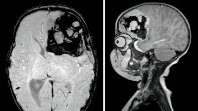 Blutung im transversalen als auch im saggitalen Schnitt