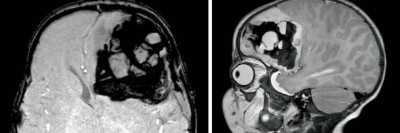 Blutung im transversalen als auch im saggitalen Schnitt
