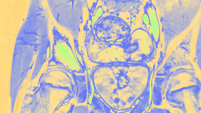 Leitthema: Infektionen und Entzündungen des Knochens - Titelbild