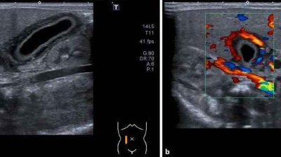 Akute akalkulöse neonatale Cholezystitis bei Frühgeborenem