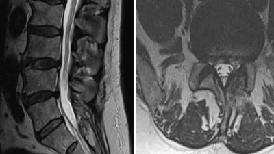 MRT der Lendenwirbelsäule