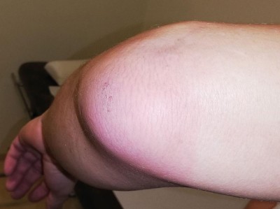 Schmerzhafte Schwellung des linken Ellenbogens