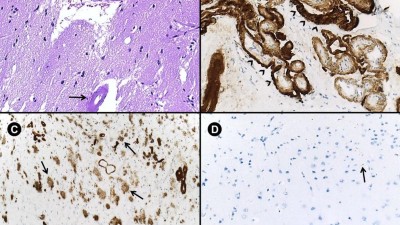 Image from case study_Neuropathological findings in iatrogenic cerebral amyloid angiopathy