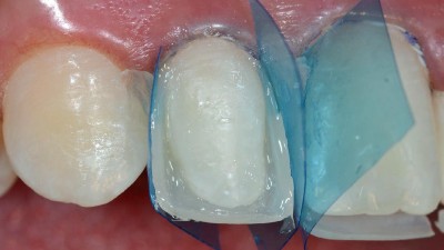 Beispiel einer Mehrschicht- und Mehrfarbentechnik. Aufbau der approximalen Schmelzwände der Zähne 11 und 12 mit individueller Verschalungstechnik und einem Farbverlauf von inzisal nach zervikal