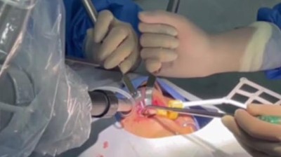 Osteotomy procedure. Mehrere Hände halten an einem zur OP abgedeckten Gesicht Abhalter in den offenen Mund eines Patienten. Von links ist ein länglicher, mechanisch-robotischer Arm zu sehen, dessen Spitze zum Mund führt.