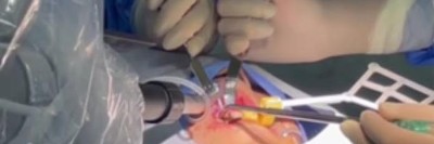 Osteotomy procedure. Mehrere Hände halten an einem zur OP abgedeckten Gesicht Abhalter in den offenen Mund eines Patienten. Von links ist ein länglicher, mechanisch-robotischer Arm zu sehen, dessen Spitze zum Mund führt.